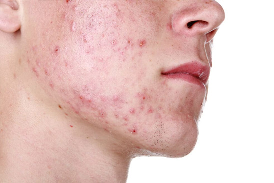 Acne en onzuivere huid